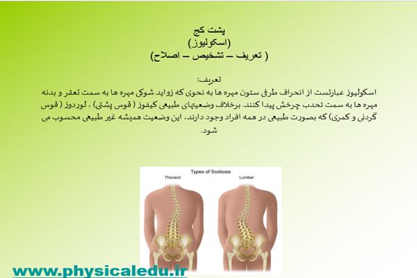 پاورپوینت اسکولیوز