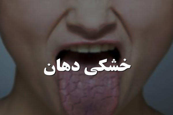 پاورپوینت خشکی دهان