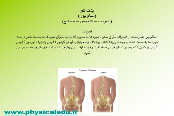 پاورپوینت پشت کج