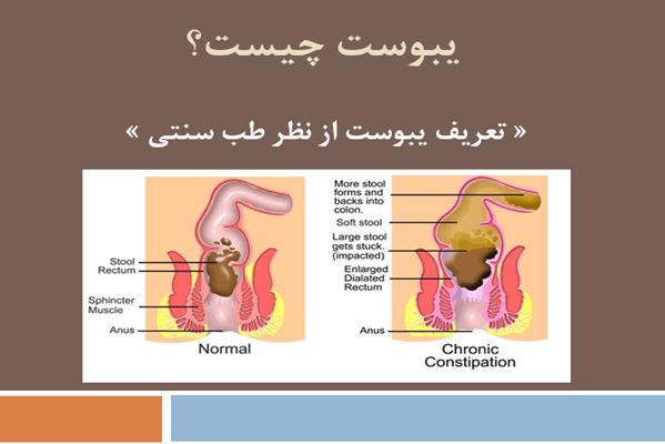 پاورپوینت یبوست چیست